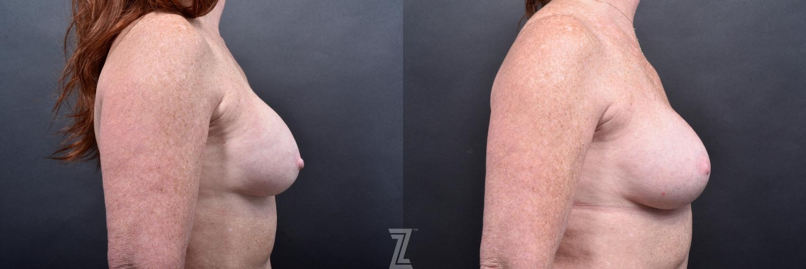 Austin Breast Augmentation Revision Before & After Gallery - Patient 132886568 - Image 5 - The Piazza Center
