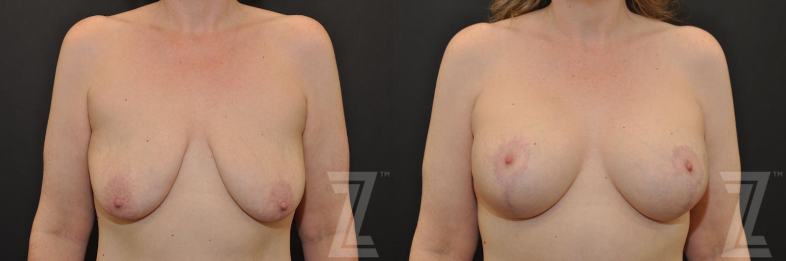 Austin Breast Augmentation With a Breast Lift Before & After Gallery - Patient 132793338 - Image 1 - The Piazza Center