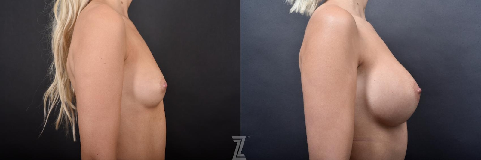 Austin Side view of before and after images of Silicone Implants with Cohesive Silicone Gel on 27 year old woman at the piazza center - The Piazza Center