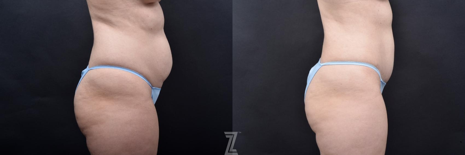Austin Skin Pinch Before & After Gallery - Patient 132886936 - Image 4 - The Piazza Center