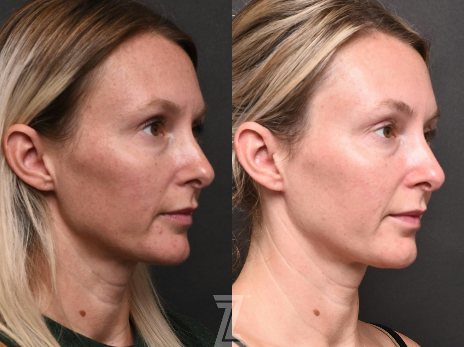 Austin BBL Before & After Gallery - Patient 132963253 - Image 2 - The Piazza Center