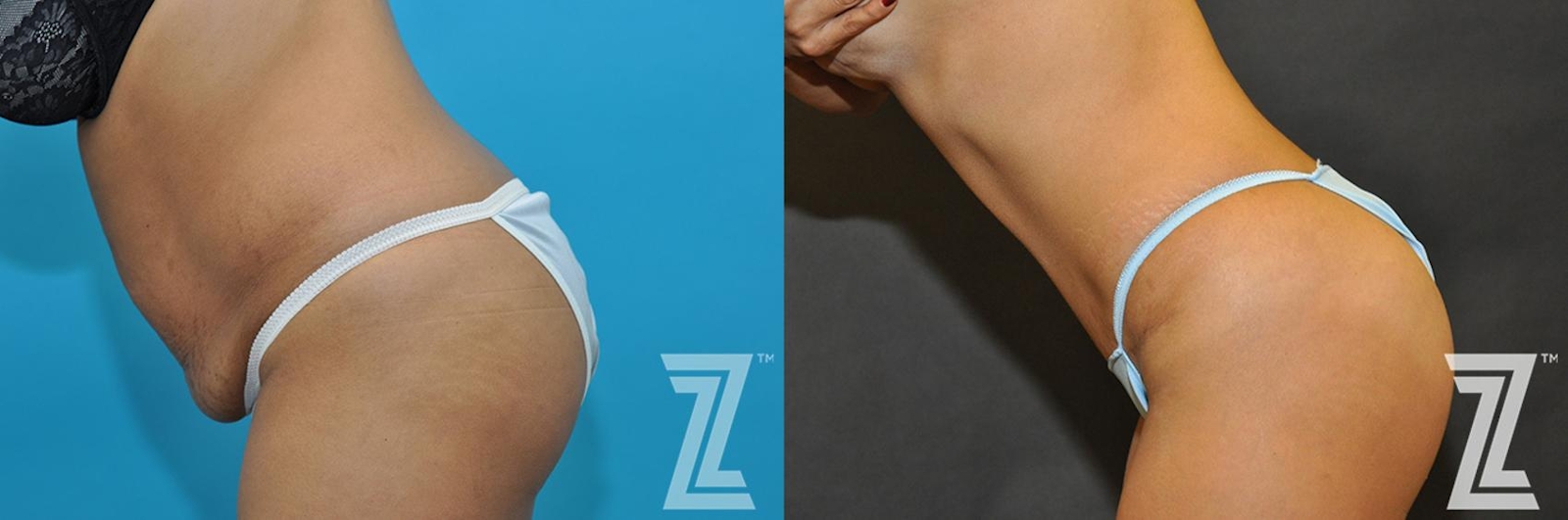 Austin Tummy Tuck Before & After Gallery - Patient 132886888 - Image 3 - The Piazza Center