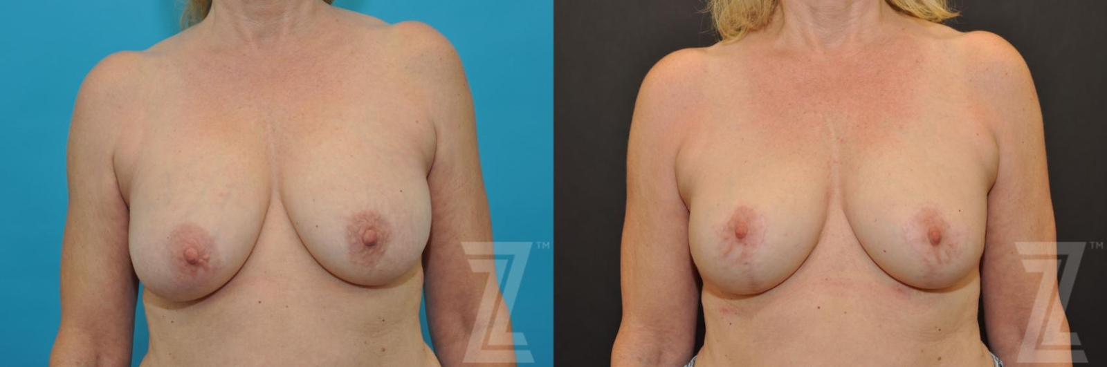Austin Breast Augmentation Revision Before & After Gallery - Patient 132793346 - Image 1 - The Piazza Center