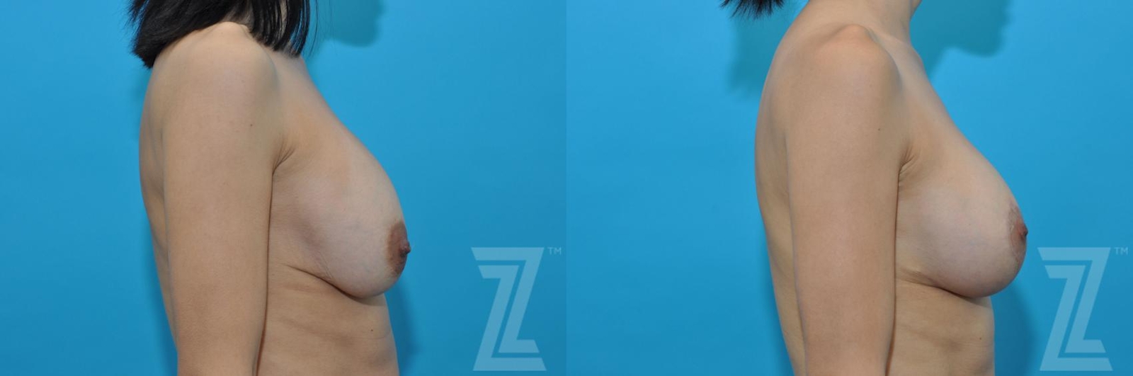 Austin Breast Augmentation Revision Before & After Gallery - Patient 132886578 - Image 3 - The Piazza Center