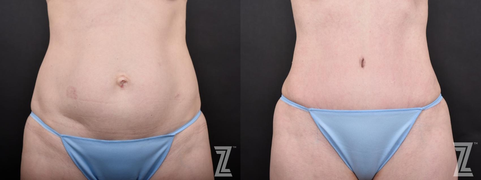 Austin Tummy View from Mommy Makeover with Surgical Plan for a Breast Augmentation and a Contoured Waistline With an Abdominoplasty in Austin, TX by Dr. Rocco Piazza - Before & After - The Piazza Center
