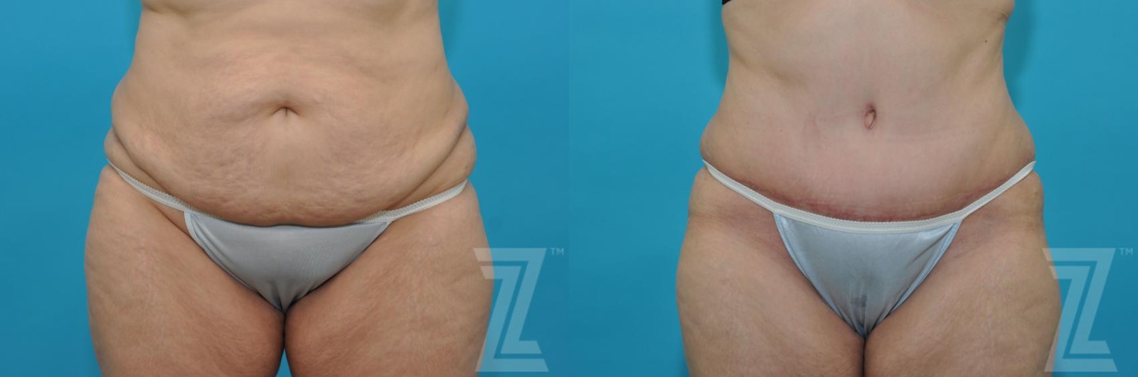 Austin Tummy Tuck Before & After Gallery - Patient 132886829 - Image 1 - The Piazza Center