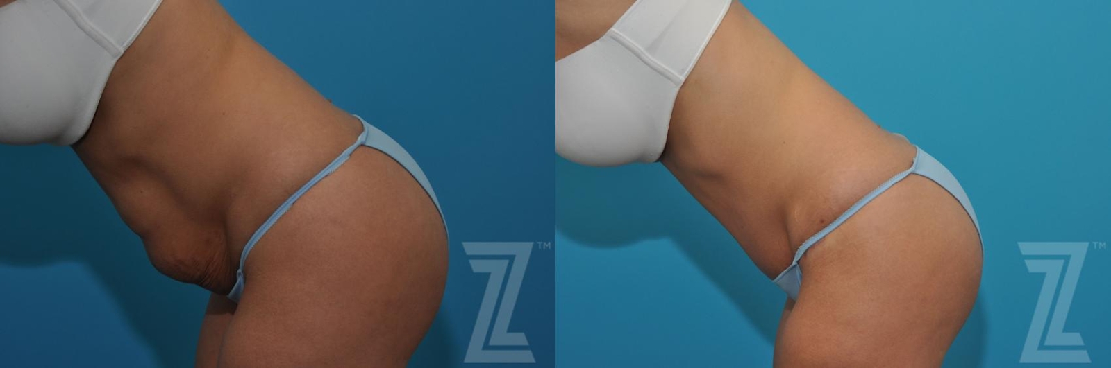 Austin Tummy Tuck Before & After Gallery - Patient 132886876 - Image 3 - The Piazza Center