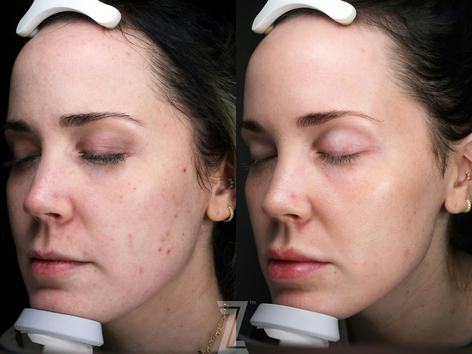 Austin Wrinkle Relaxers Before & After Gallery - Patient 780296 - Image 1 - The Piazza Center