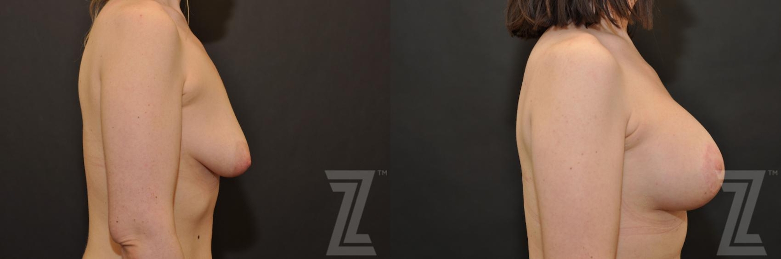 Austin Correction of Breast Asymmetry Before & After Gallery - Patient 132886780 - Image 5 - The Piazza Center