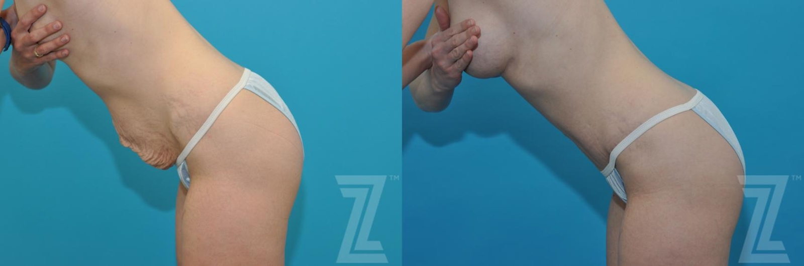 Austin Tummy Tuck Before & After Gallery - Patient 132886867 - Image 3 - The Piazza Center