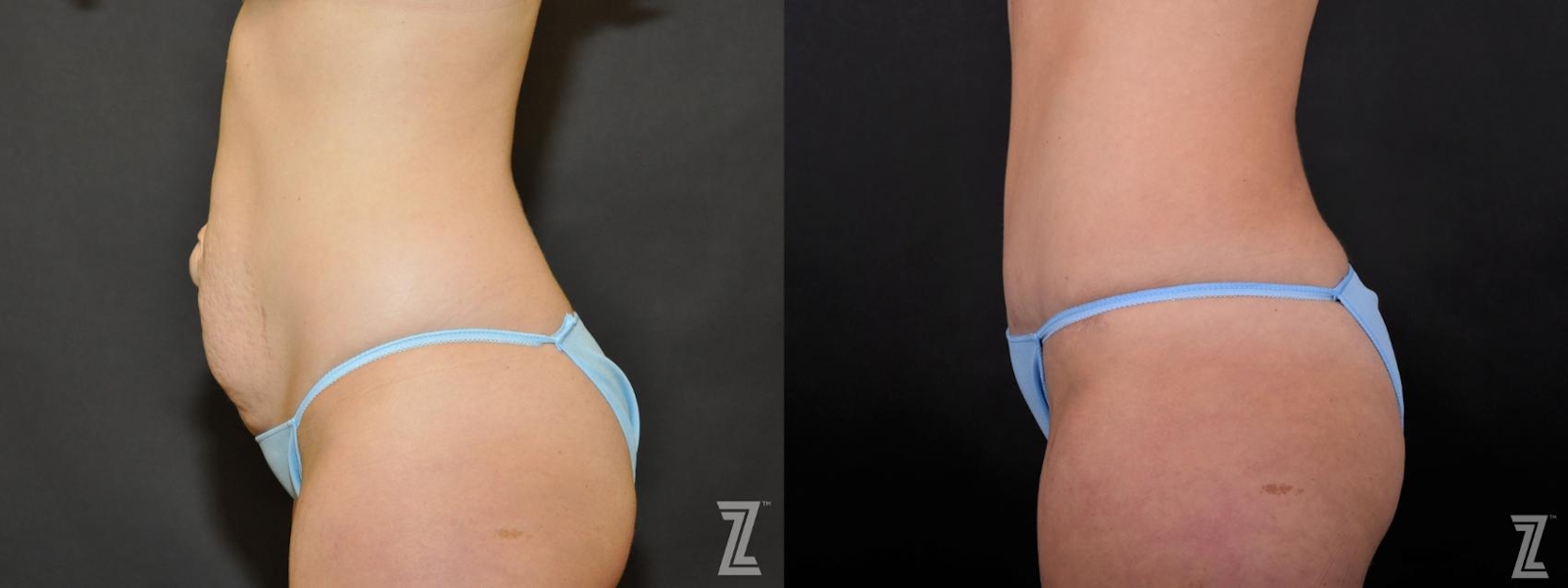 Austin Tummy Tuck Before & After Gallery - Patient 132886895 - Image 2 - The Piazza Center