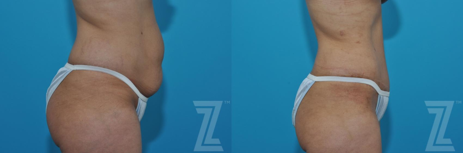 Austin Tummy Tuck Before & After Gallery - Patient 132886901 - Image 4 - The Piazza Center