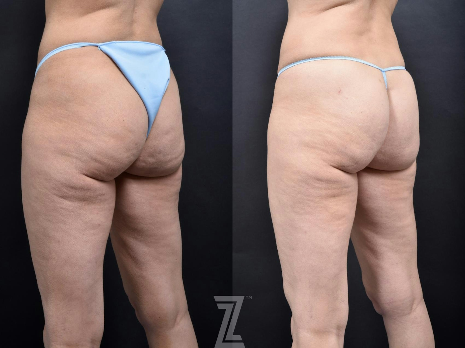 Austin Avéli Before & After Gallery - Patient 132905407 - Image 2 - The Piazza Center