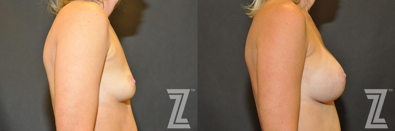 Austin Side view before & after images of 35-year-old mother of two 8 month post op breast augmentation - Dr. Rocco Piazza - The Piazza Center