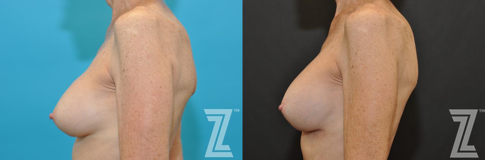 Austin Breast Augmentation Revision Before & After Gallery - Patient 132793347 - Image 3 - The Piazza Center
