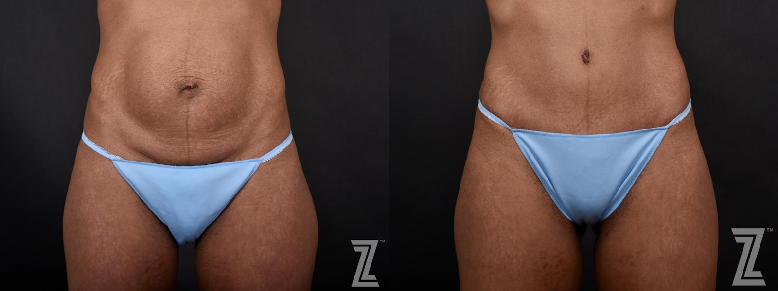 Austin 34-Year-Old Mom with Three Children Mommy Makeover Before & After by Dr. Rocco Piazza in Austin, Texas - Frontal View of Abdomen - The Piazza Center
