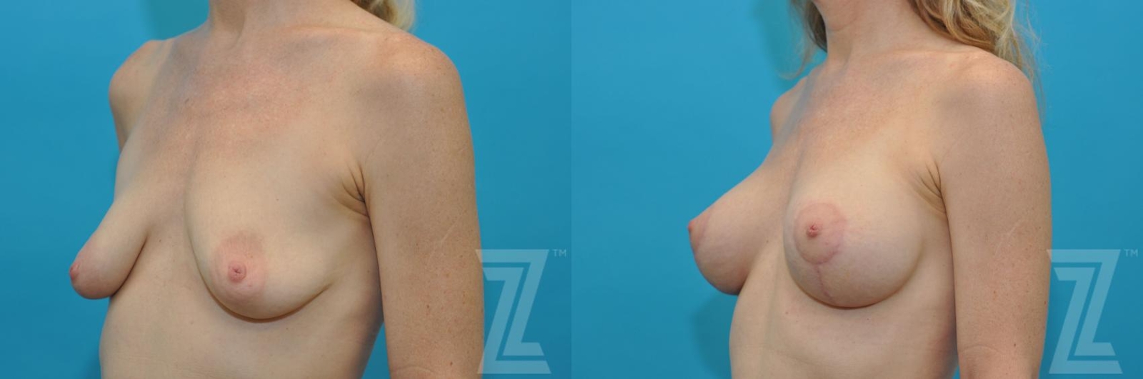 Austin Breast Lift Before & After Gallery - Patient 132791069 - Image 2 - The Piazza Center