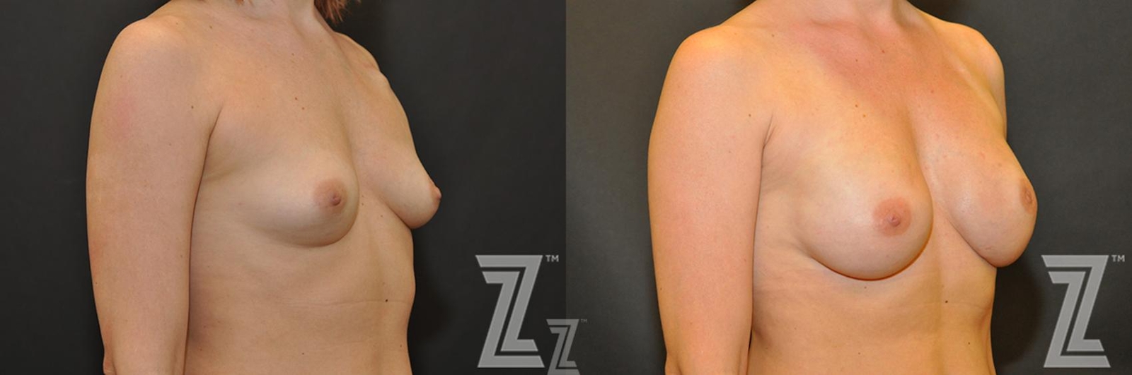 Austin Breast Reconstruction Before & After Gallery - Patient 132886763 - Image 4 - The Piazza Center