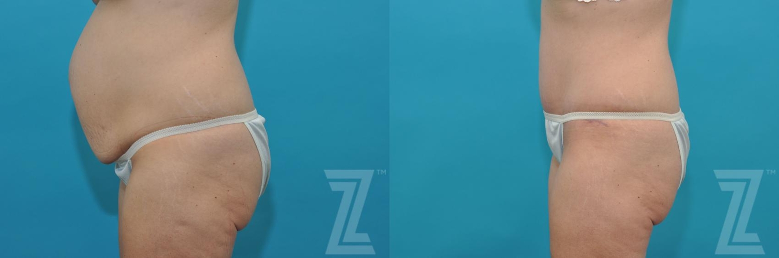 Austin Tummy Tuck Before & After Gallery - Patient 132886822 - Image 2 - The Piazza Center