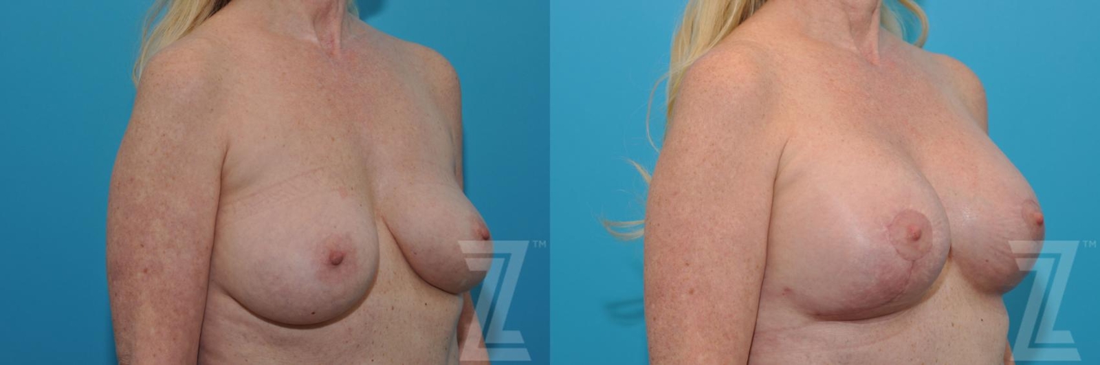 Austin Breast Augmentation Revision Before & After Gallery - Patient 132794909 - Image 4 - The Piazza Center