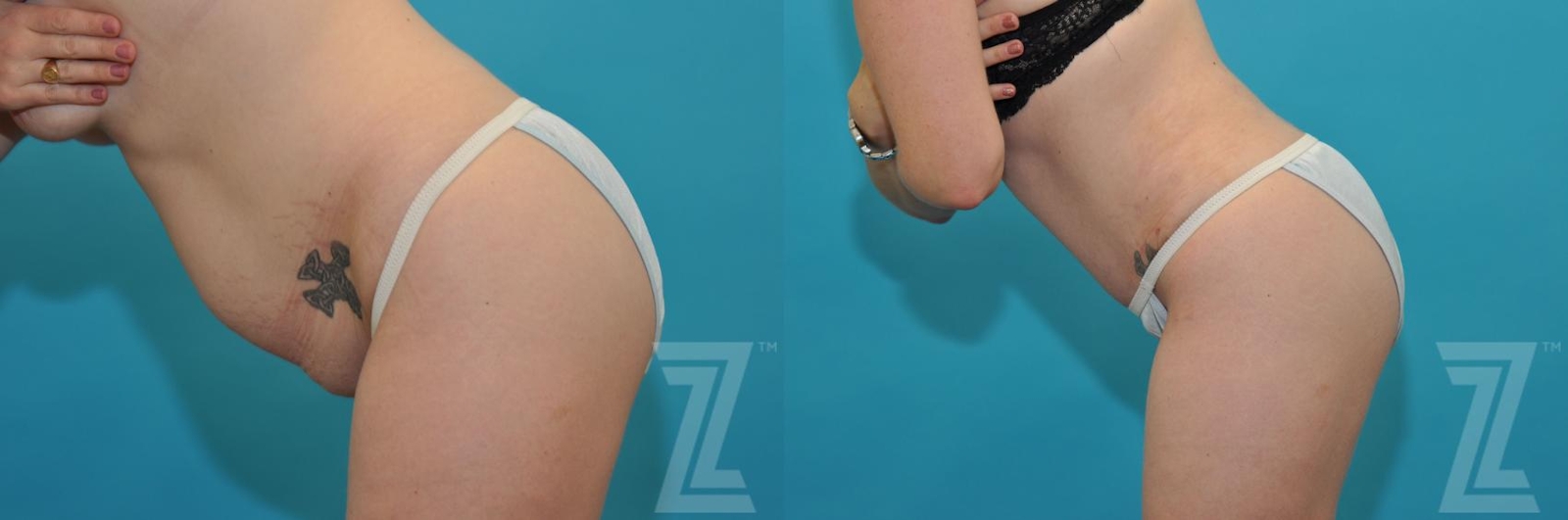 Austin Tummy Tuck Before & After Gallery - Patient 132886890 - Image 3 - The Piazza Center