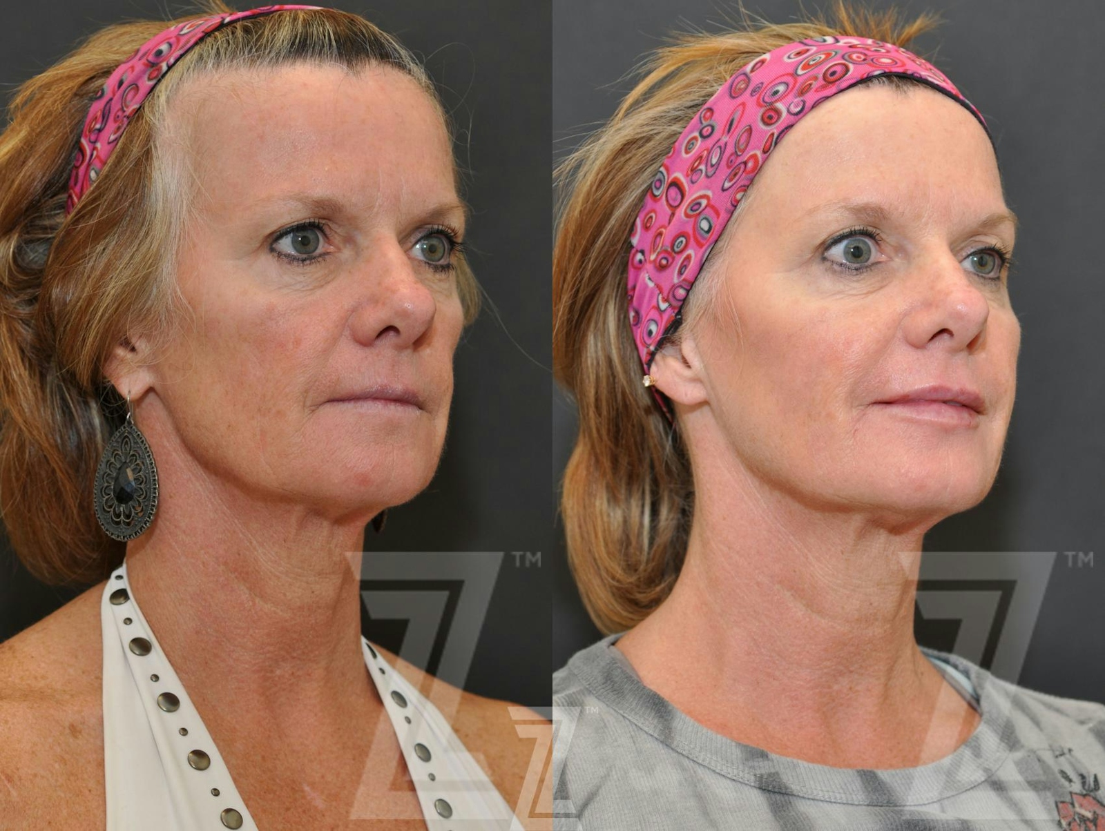 Austin Injectable Fillers Before & After Gallery - Patient 132963114 - Image 2 - The Piazza Center