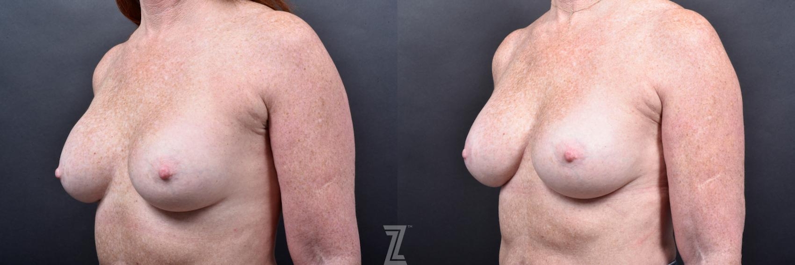 Austin Breast Augmentation Revision Before & After Gallery - Patient 132886568 - Image 2 - The Piazza Center