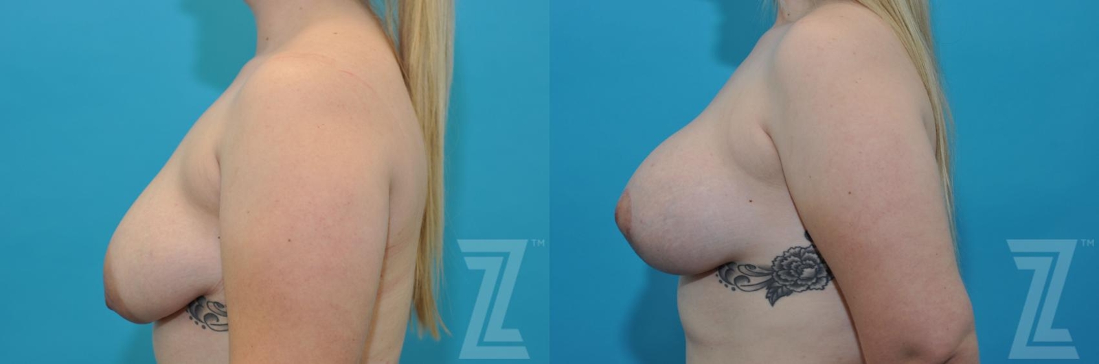Austin Correction of Breast Asymmetry Before & After Gallery - Patient 132886777 - Image 3 - The Piazza Center