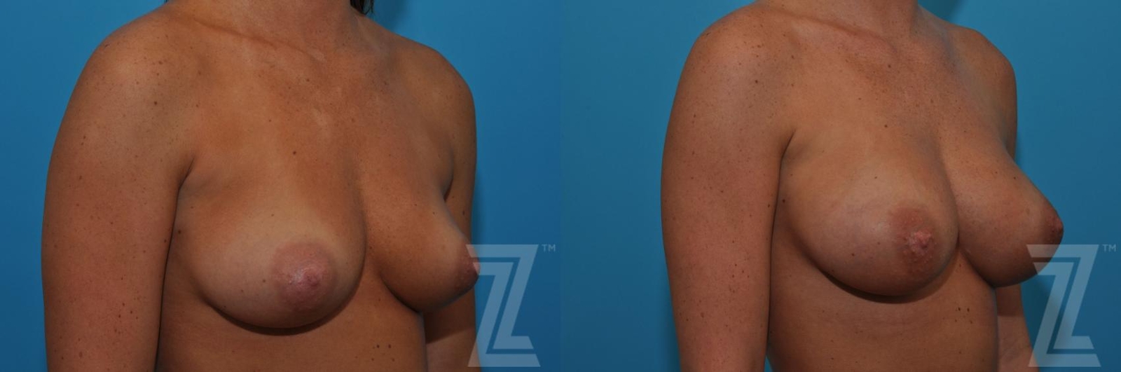 Austin Correction of Breast Asymmetry Before & After Gallery - Patient 132886779 - Image 4 - The Piazza Center