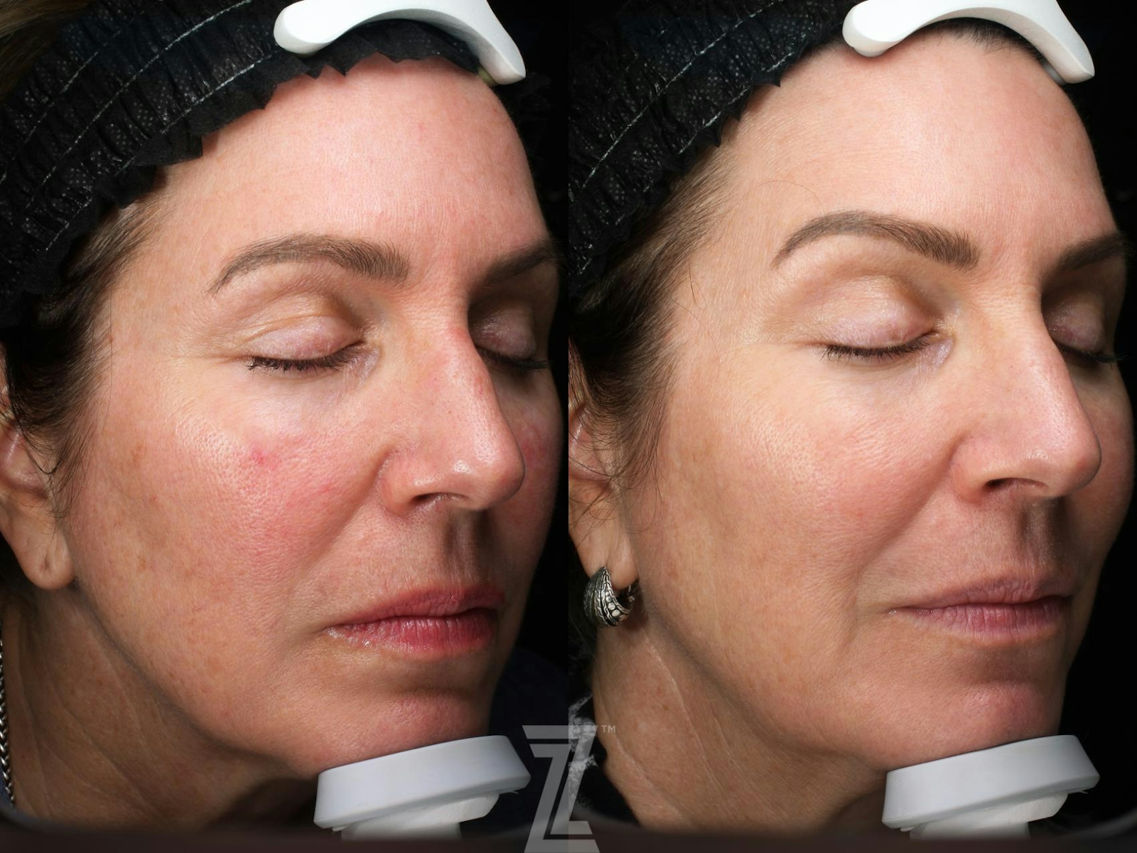 Austin Moxi Before & After Gallery - Patient 362380 - Image 3 - The Piazza Center