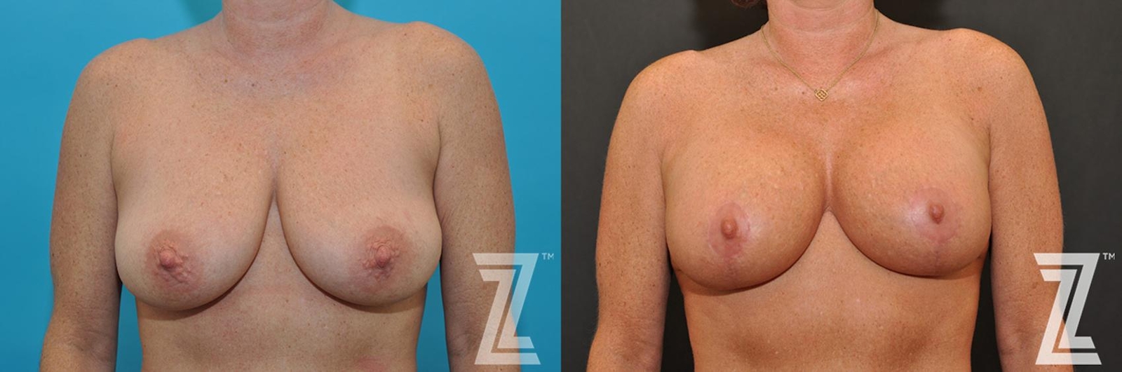 Austin Breast Augmentation With a Breast Lift Before & After Gallery - Patient 132791107 - Image 1 - The Piazza Center