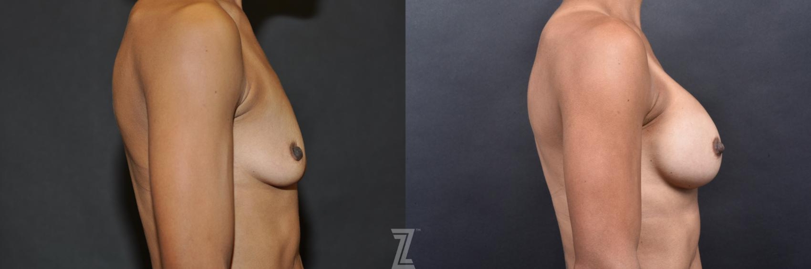 Austin Lateral view before & after images of 35-year-old mother with breat augmentation - Dr. Rocco Piazza - The Piazza Center