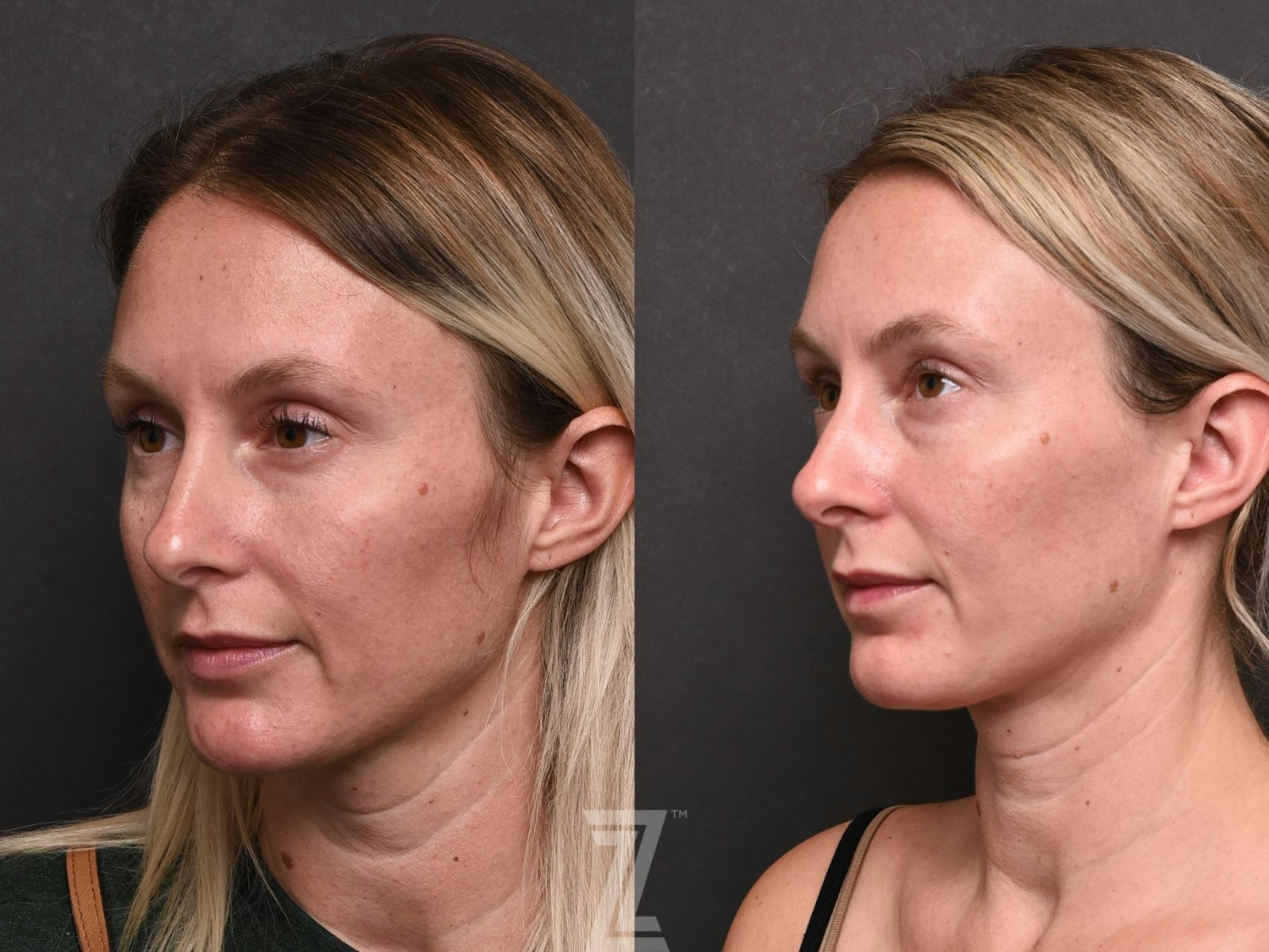 Austin BBL Before & After Gallery - Patient 132963253 - Image 3 - The Piazza Center