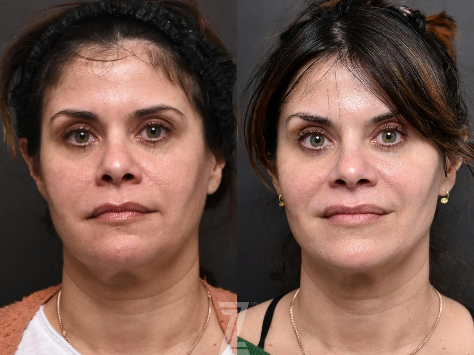 Austin Facial Rejuvenation Before & After Gallery - Patient 189397 - Image 1 - The Piazza Center