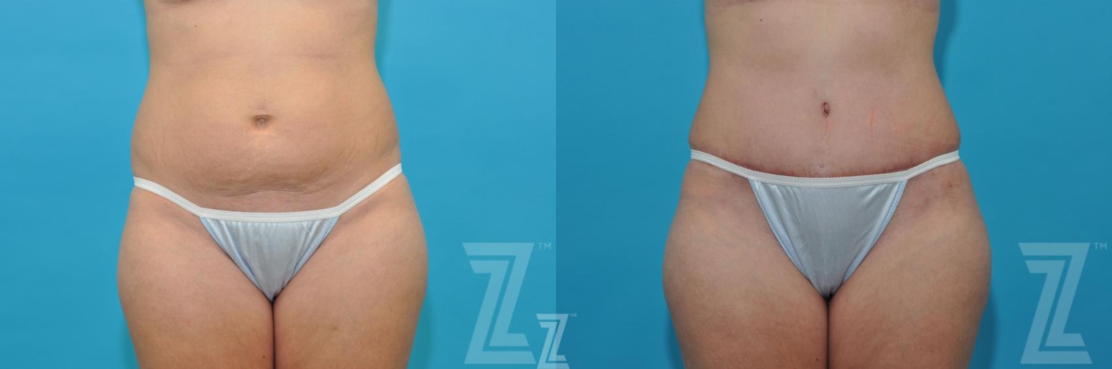 Austin Before & After images frontal abdominal view of 40-year-old mother of five mommy maker over - Dr. Rocco Piazza, Austin TX - The Piazza Center
