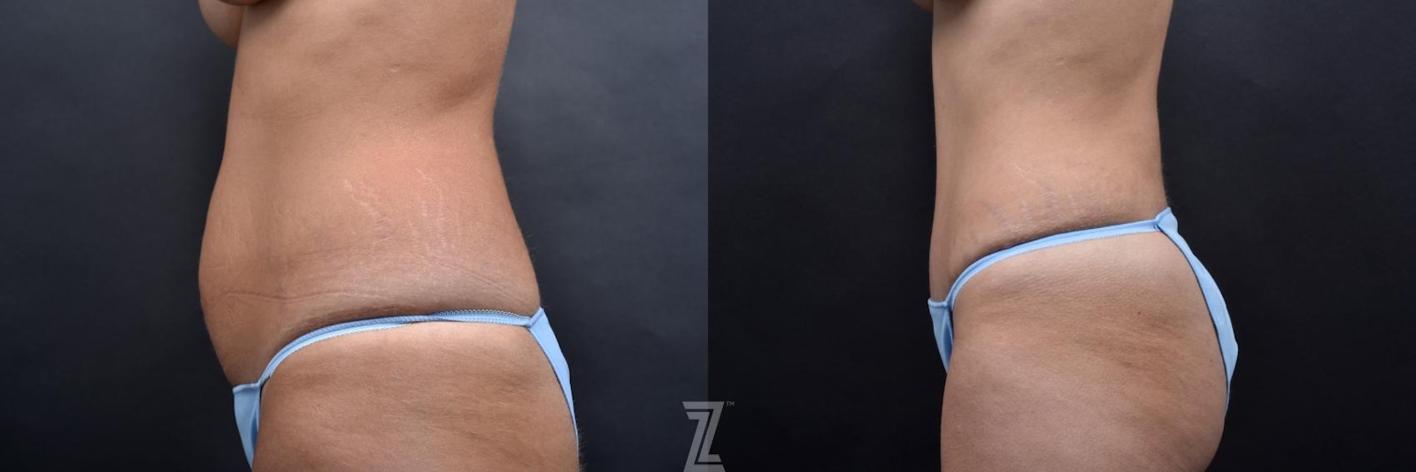Austin Tummy Tuck Before & After Gallery - Patient 132886801 - Image 2 - The Piazza Center