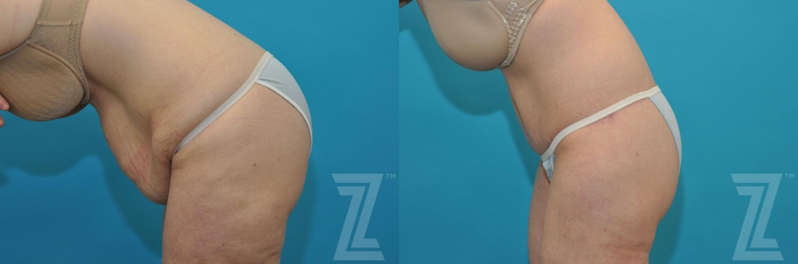 Austin Tummy Tuck Before & After Gallery - Patient 132886807 - Image 3 - The Piazza Center