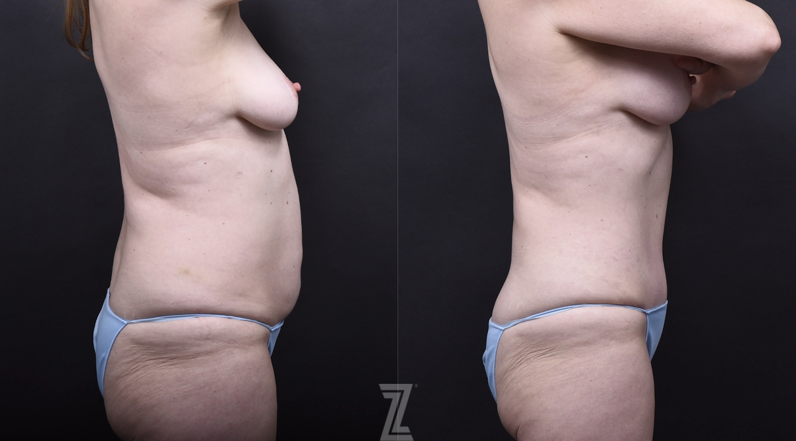 Austin Mommy Makeover Before & After Gallery - Patient 105405 - Image 2 - The Piazza Center