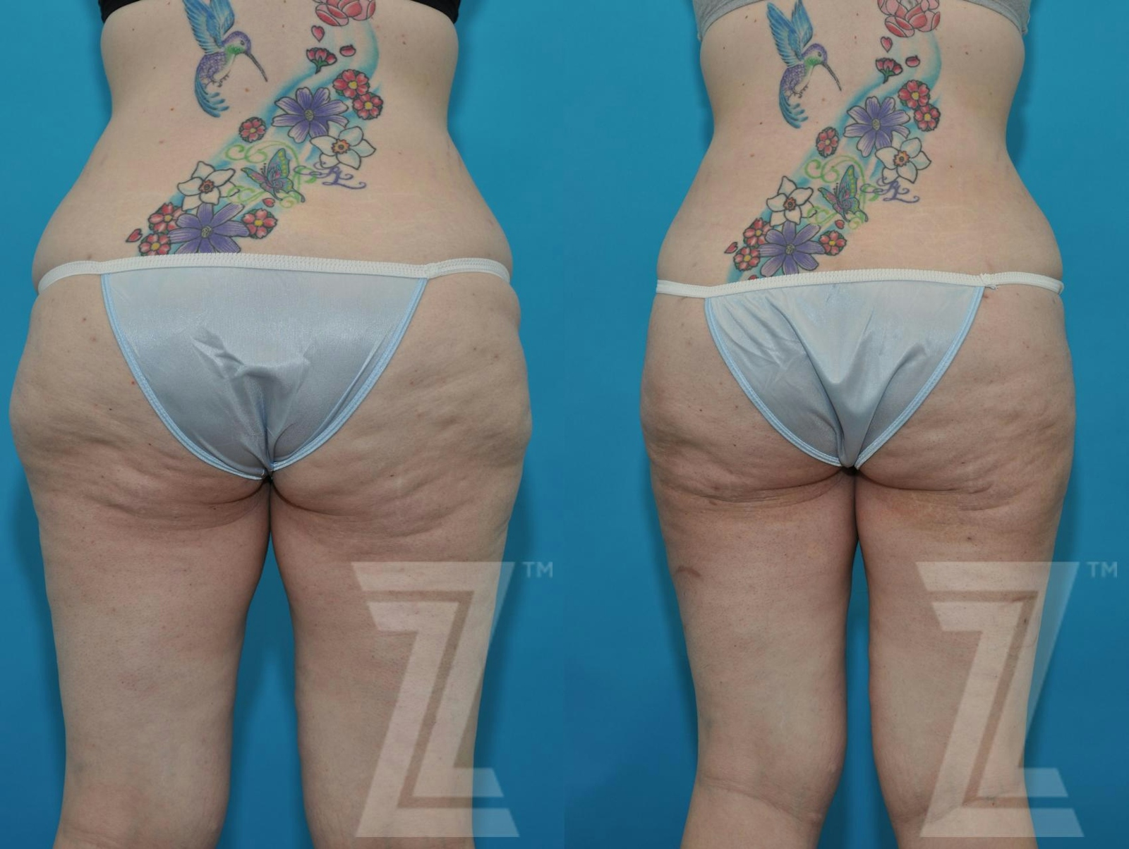 Austin Tummy Tuck Before & After Gallery - Patient 132886824 - Image 8 - The Piazza Center
