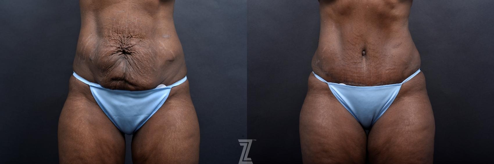 Austin Front Abdomen View 1 Year Post-OP Mommy Makeover in Austin, TX by Dr. Rocco Piazza - The Piazza Center