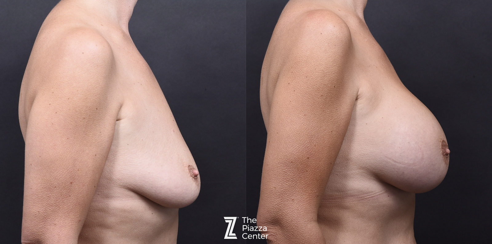 Austin Breast Augmentation Before & After Gallery - Patient 345874 - Image 3 - The Piazza Center