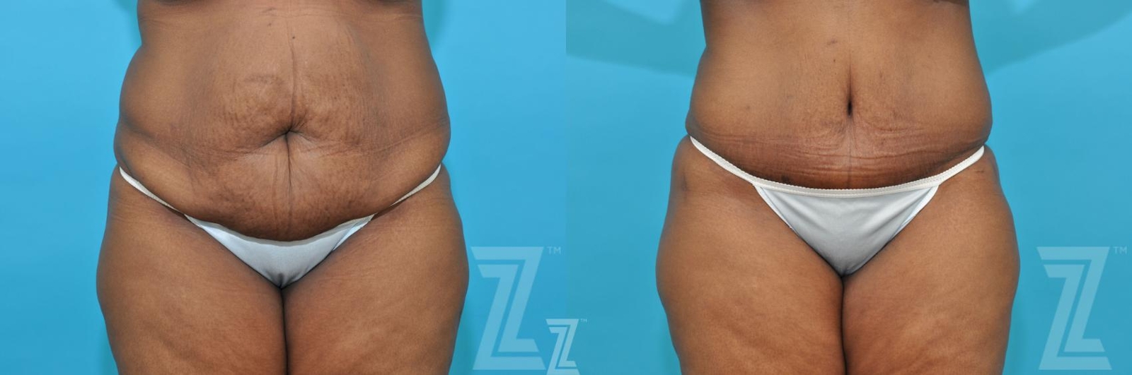 Austin Liposuction Before & After Gallery - Patient 132887164 - Image 1 - The Piazza Center