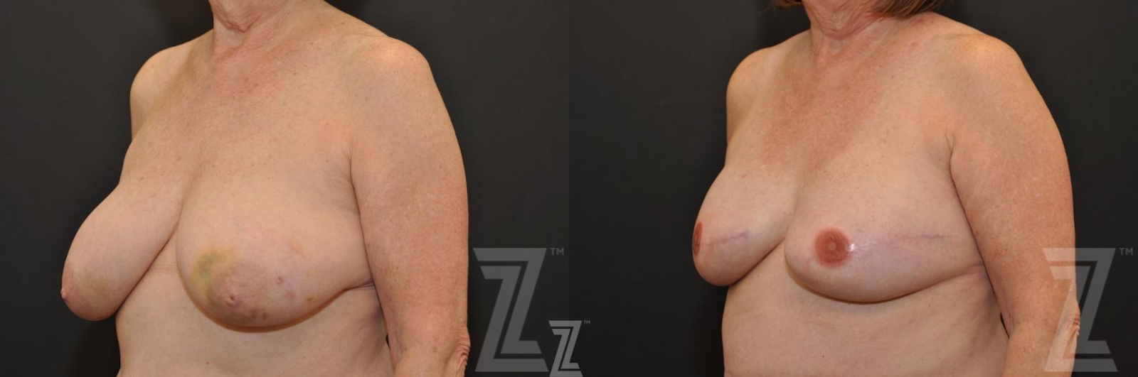 Austin Breast Reconstruction Before & After Gallery - Patient 132886766 - Image 2 - The Piazza Center