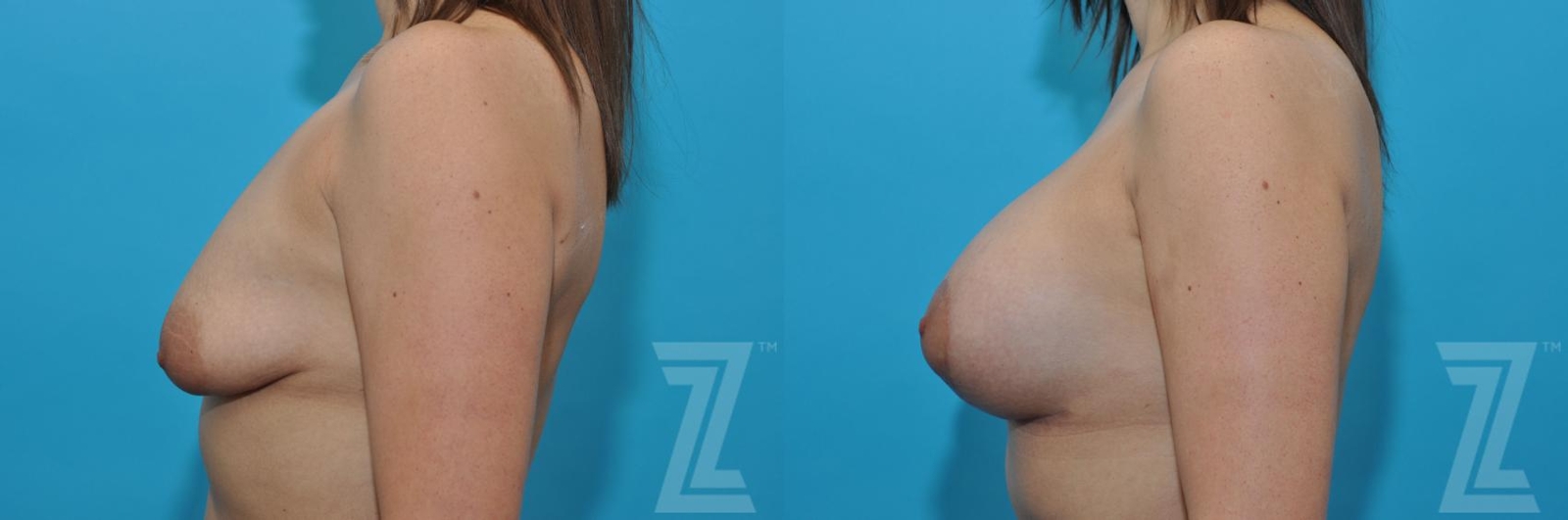 Austin Breast Augmentation With a Breast Lift Before & After Gallery - Patient 132791109 - Image 4 - The Piazza Center