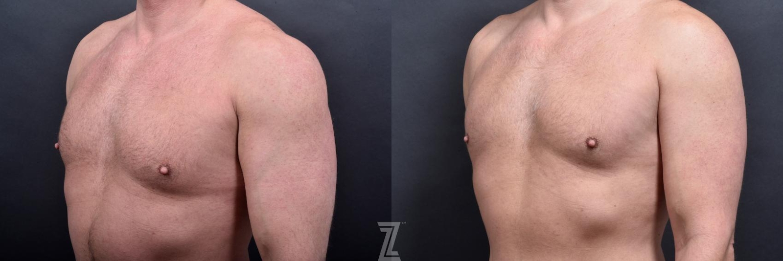 Austin Male Body Contouring Before & After Gallery - Patient 173307 - Image 4 - The Piazza Center