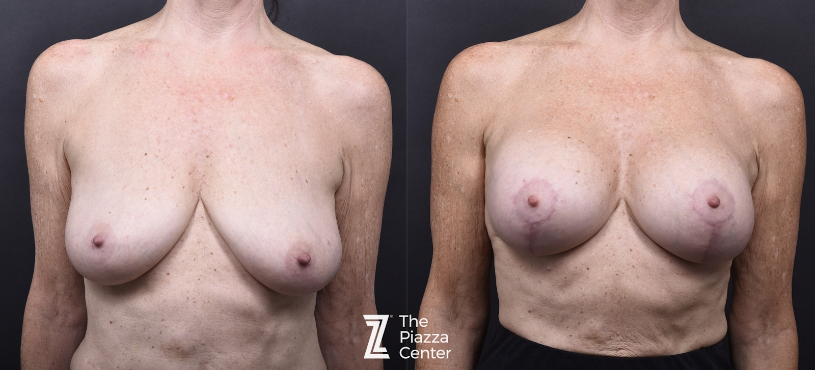 Austin Breast Augmentation With a Breast Lift Before & After Gallery - Patient 296286 - Image 1 - The Piazza Center