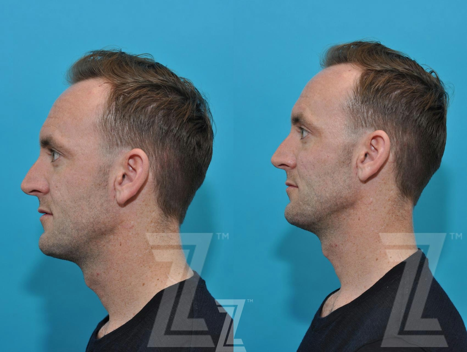 Austin Injectable Fillers Before & After Gallery - Patient 132963102 - Image 2 - The Piazza Center