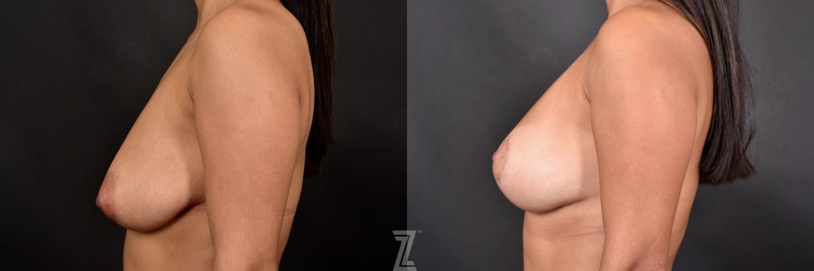 Austin Breast Lift Before & After Gallery - Patient 132791072 - Image 3 - The Piazza Center