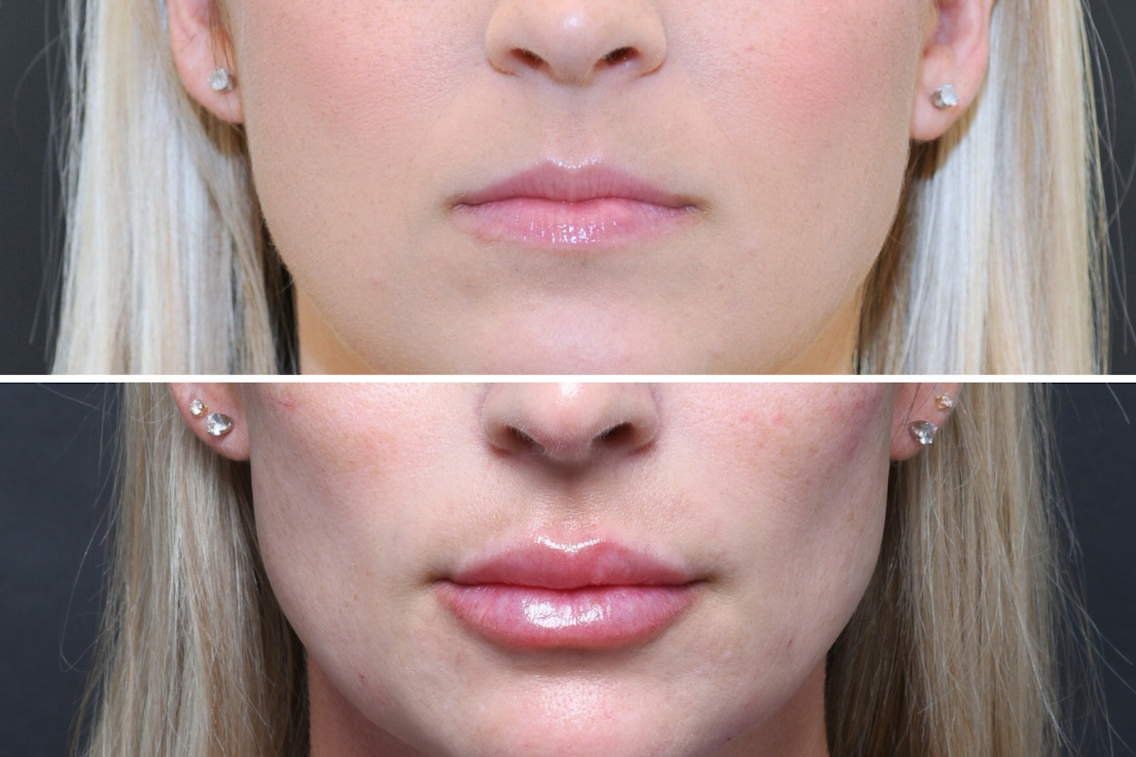 Austin Injectable Fillers Before & After Gallery - Patient 404245 - Image 3 - The Piazza Center