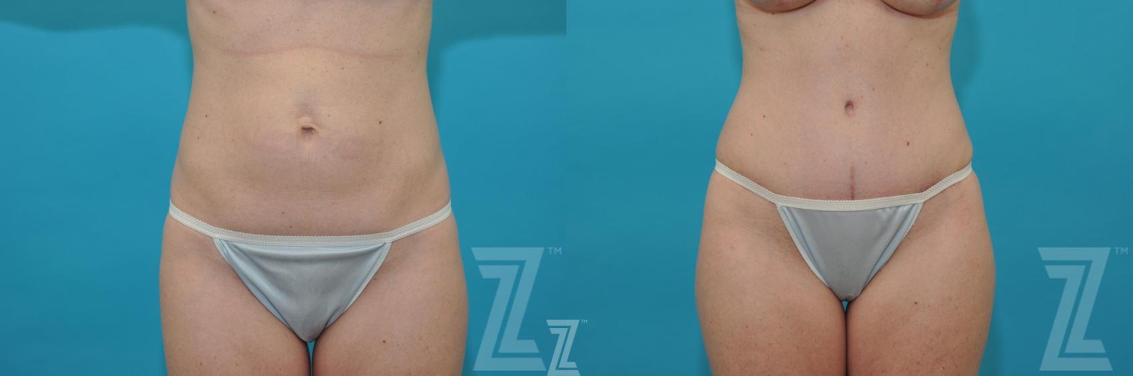Austin Frontal abdominal view before & after images of 35 year old woman mommy make over - Dr. Rocco Piazza Austin TX - The Piazza Center